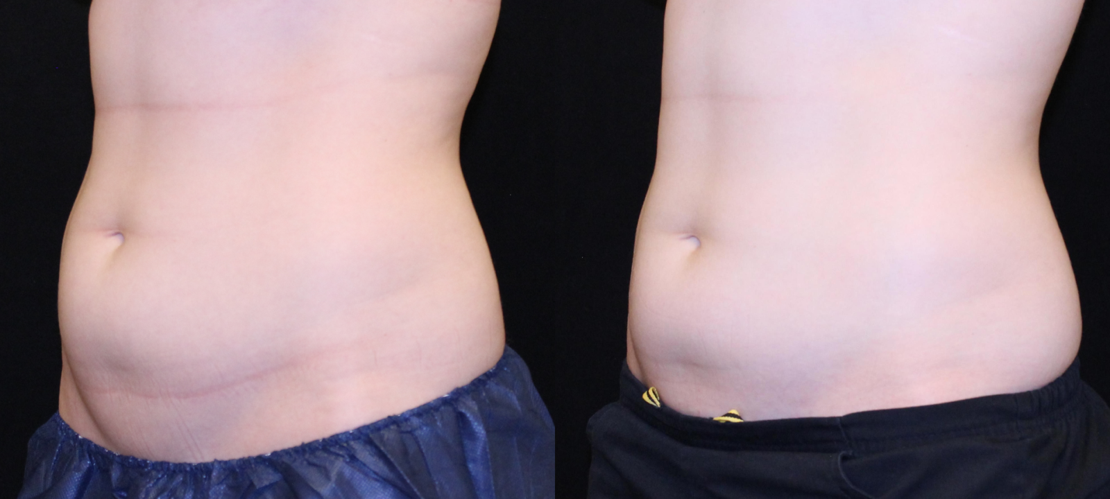 New Body Shaping Treatments of 2019 truSculpt® iD and Torc